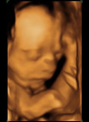 4D ultrasound
